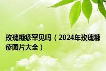 玫瑰糠疹罕见吗（2024年玫瑰糠疹图片大全）