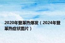 2020年登革热爆发（2024年登革热症状图片）