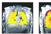 新型肺部扫描方法可实时显示治疗效果
